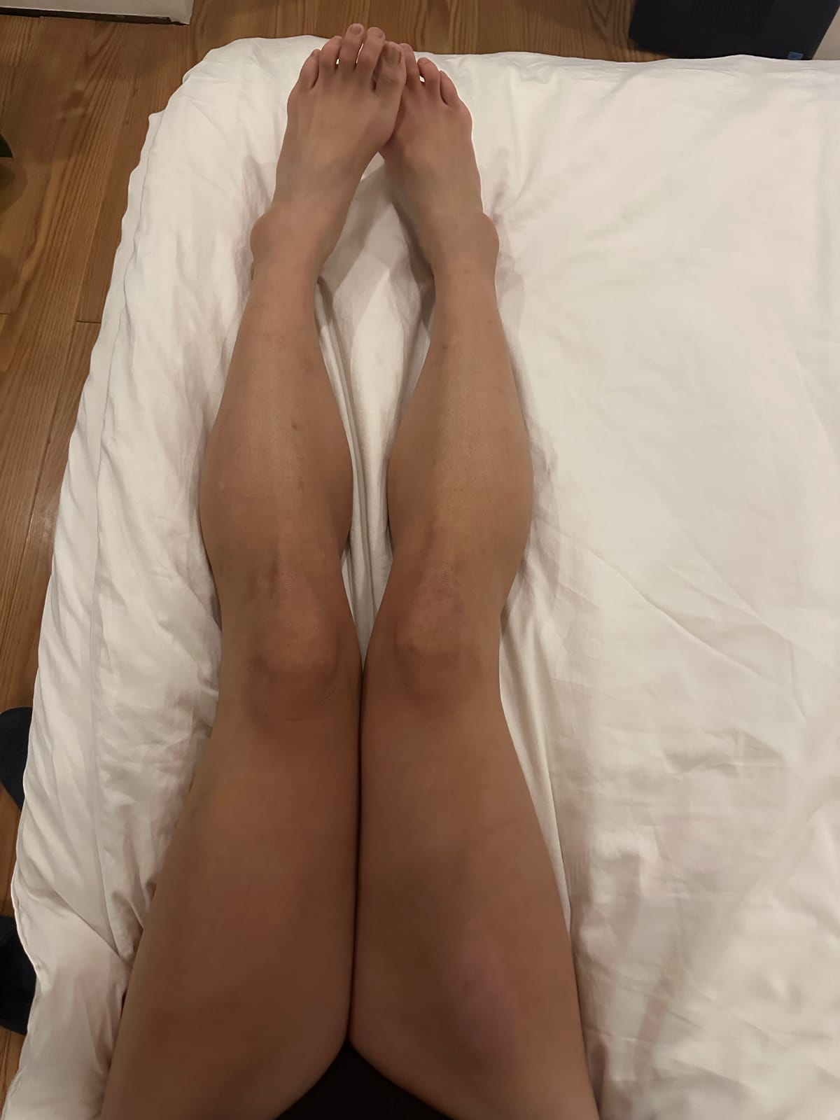 Right Knee ACL Repair Day 0