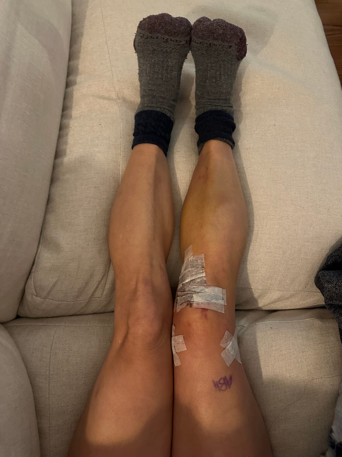 ACL Repair Day 6
